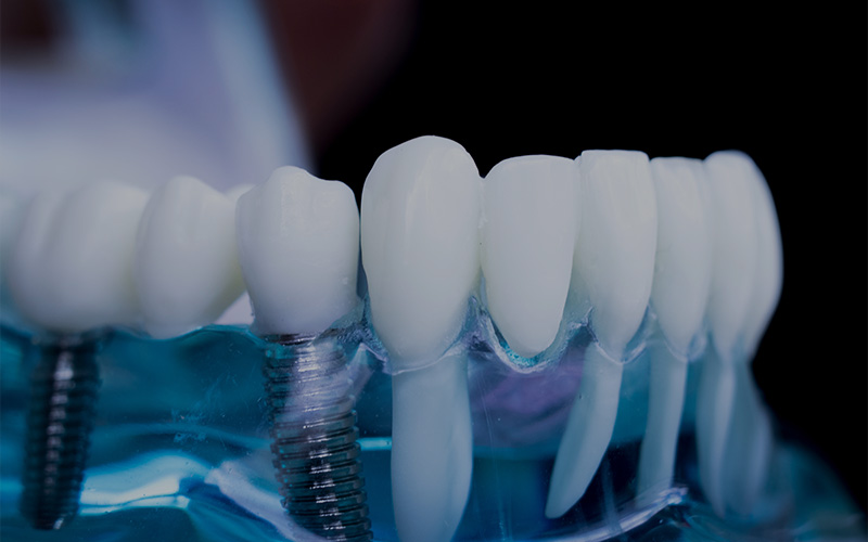Impianti dentali