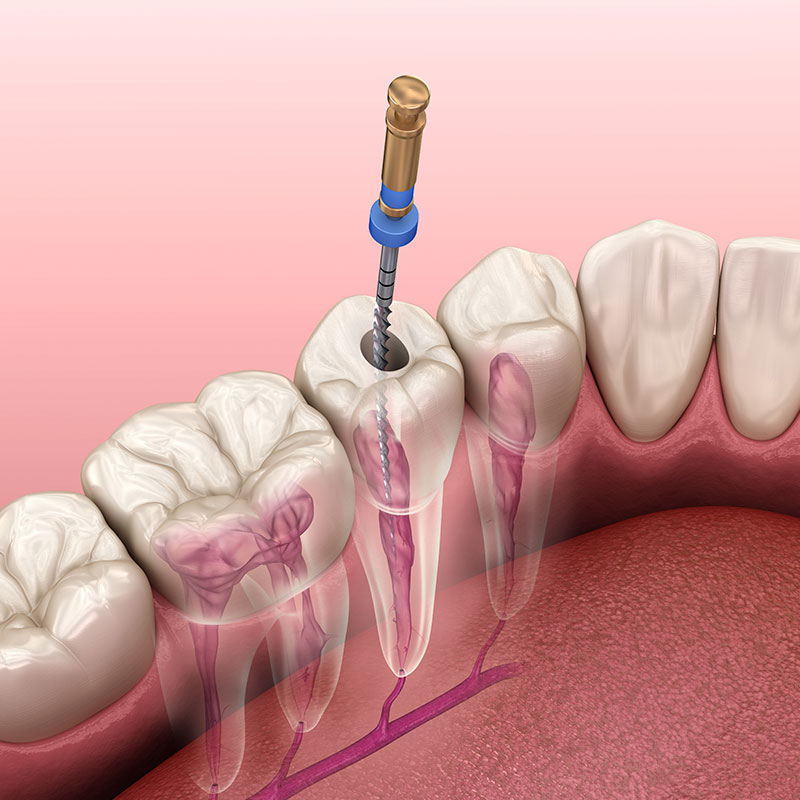 Devitalizzazione dente