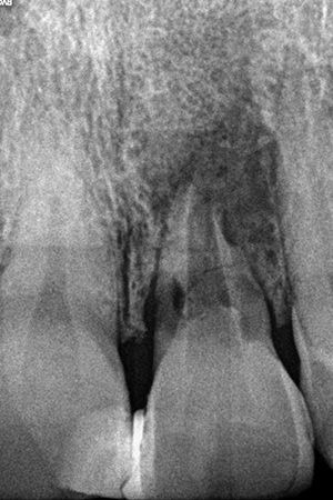 Impianti dentali Casi clinici