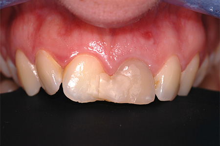 Impianti dentali Casi clinici