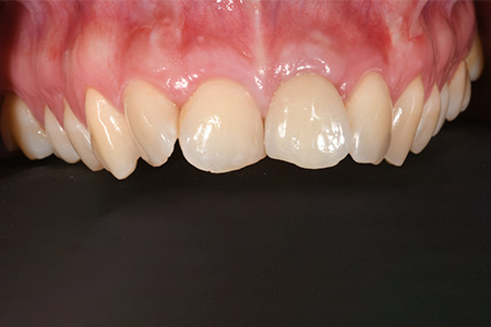 Impianti dentali Casi clinici