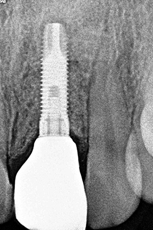 Impianti dentali Casi clinici