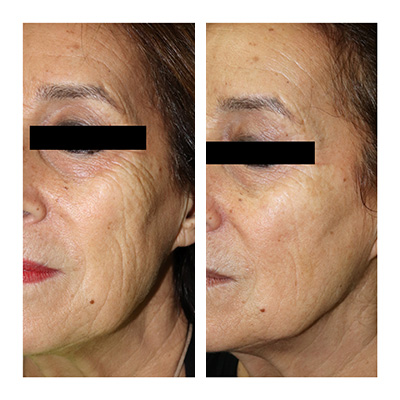 Anti Aging Anti Aging