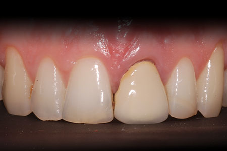 Corone su denti ed impianti Corone su denti ed impianti