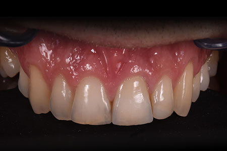 Corone su denti ed impianti Corone su denti ed impianti