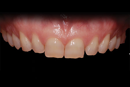 Faccette dentali Faccette dentali