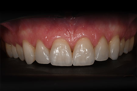 Faccette dentali Faccette dentali