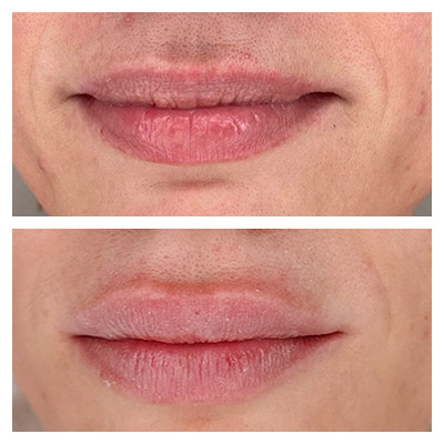 Lip Filler Lip Filler